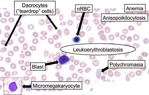 Myelophthisic Anemia .